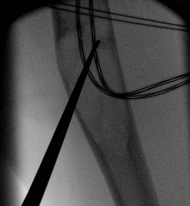 UBC Humerus Curettage